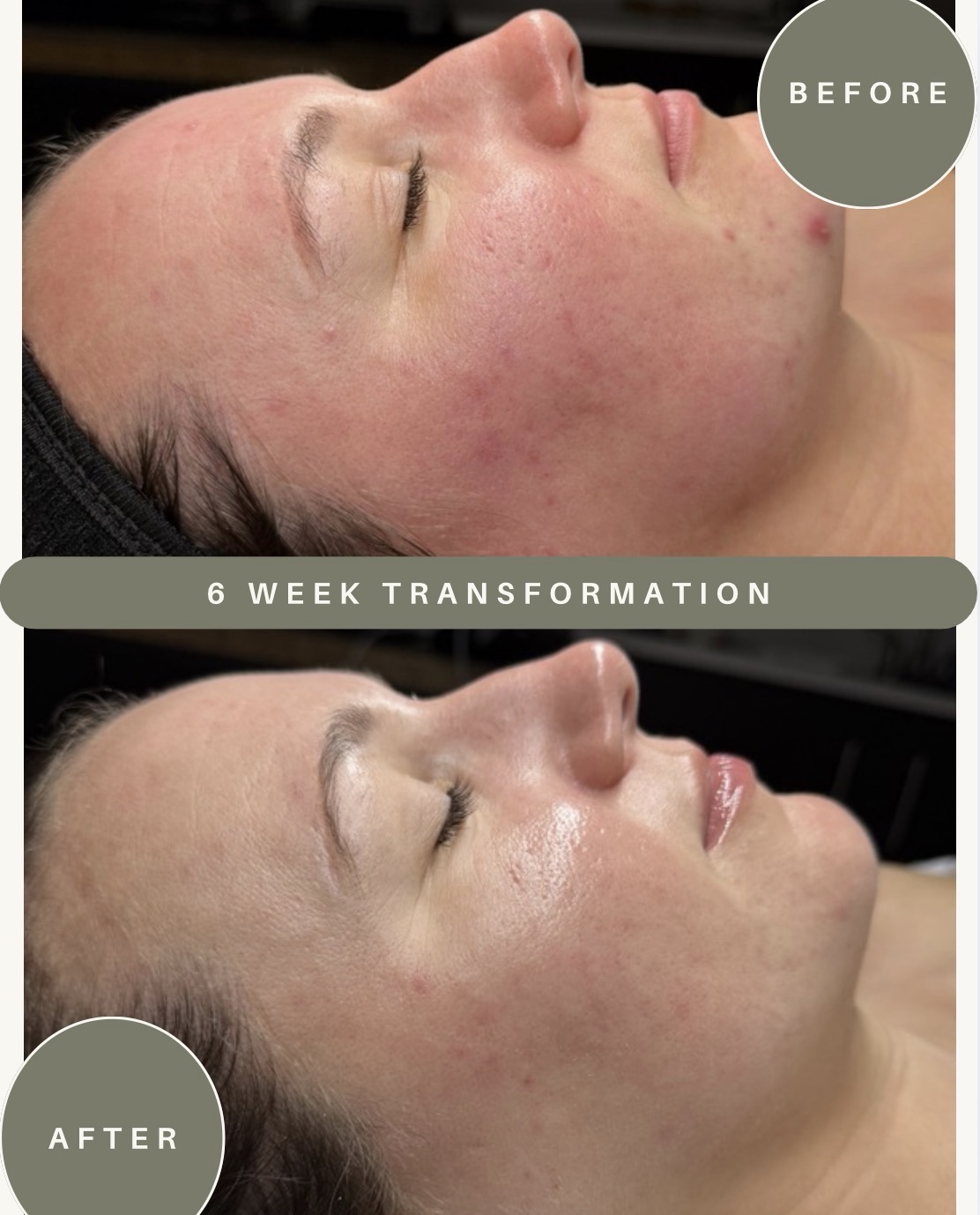 6 week skin transformation